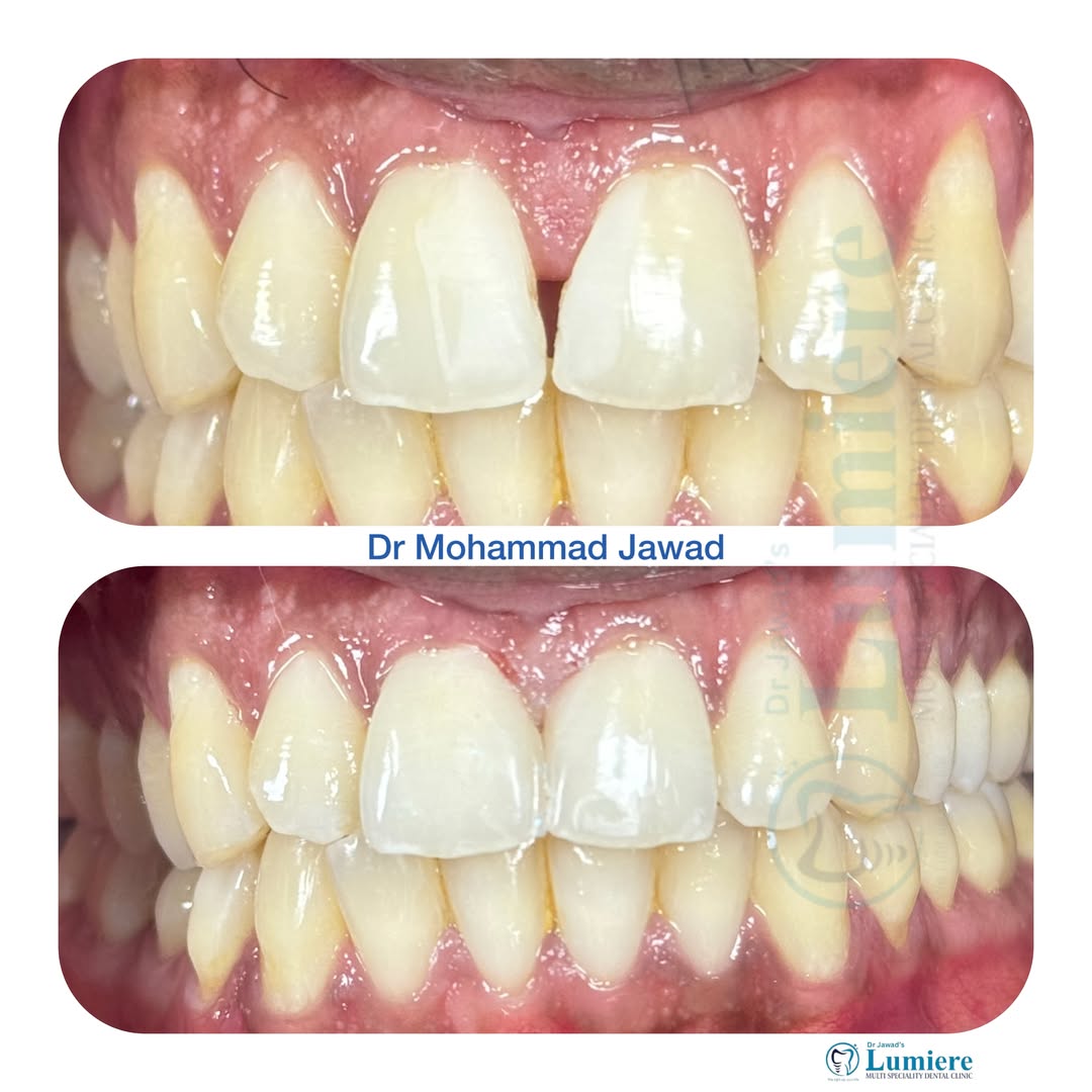 Midline Diastema Closure Before and After
